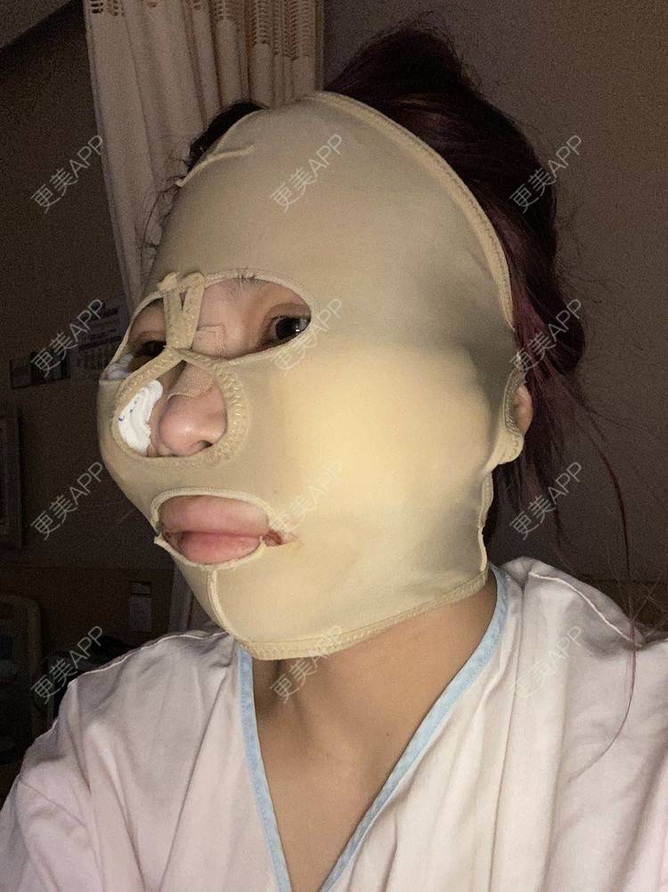 更美 - 以情之名，赌你一生颊的颧骨内推经验 | 颧骨内推 | 重庆