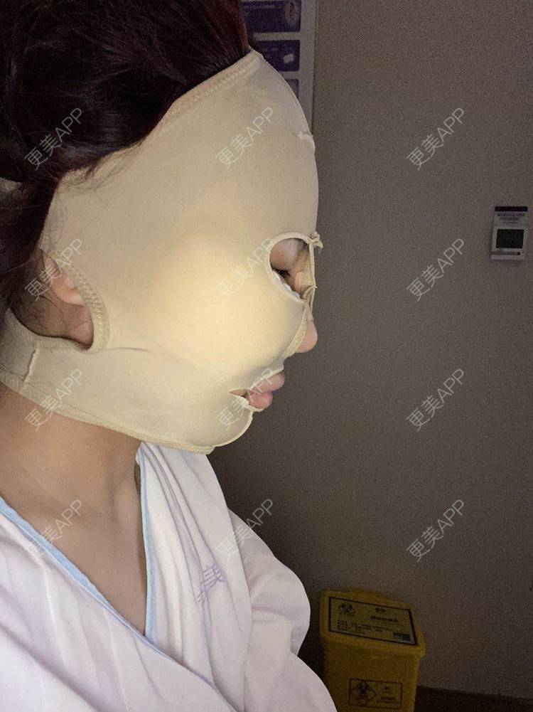 更美 - 以情之名，赌你一生颊的颧骨内推经验 | 颧骨内推 | 重庆