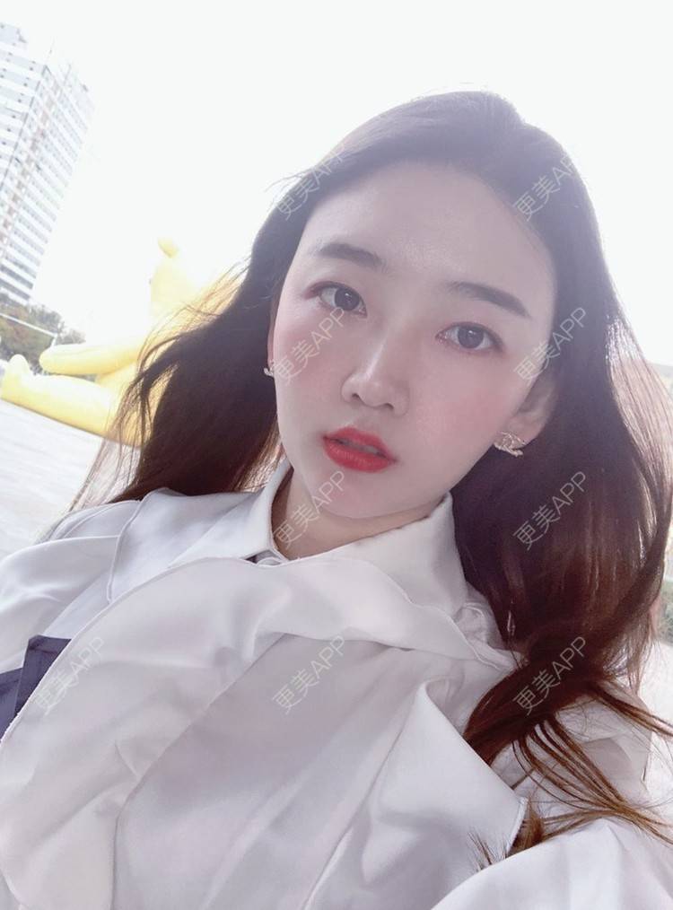 更美 - 更美用户njuluUhApQ的瘦脸经验 | V脸套餐 | 瘦脸 | 青岛