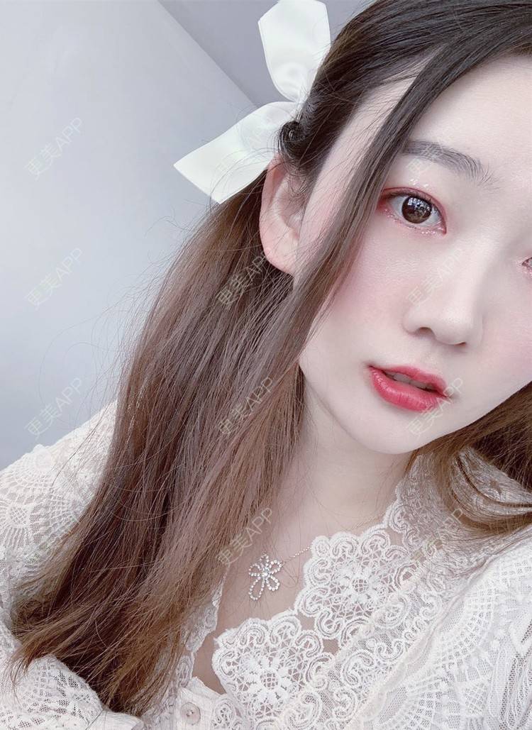 更美 - 更美用户njuluUhApQ的瘦脸经验 | V脸套餐 | 瘦脸 | 青岛