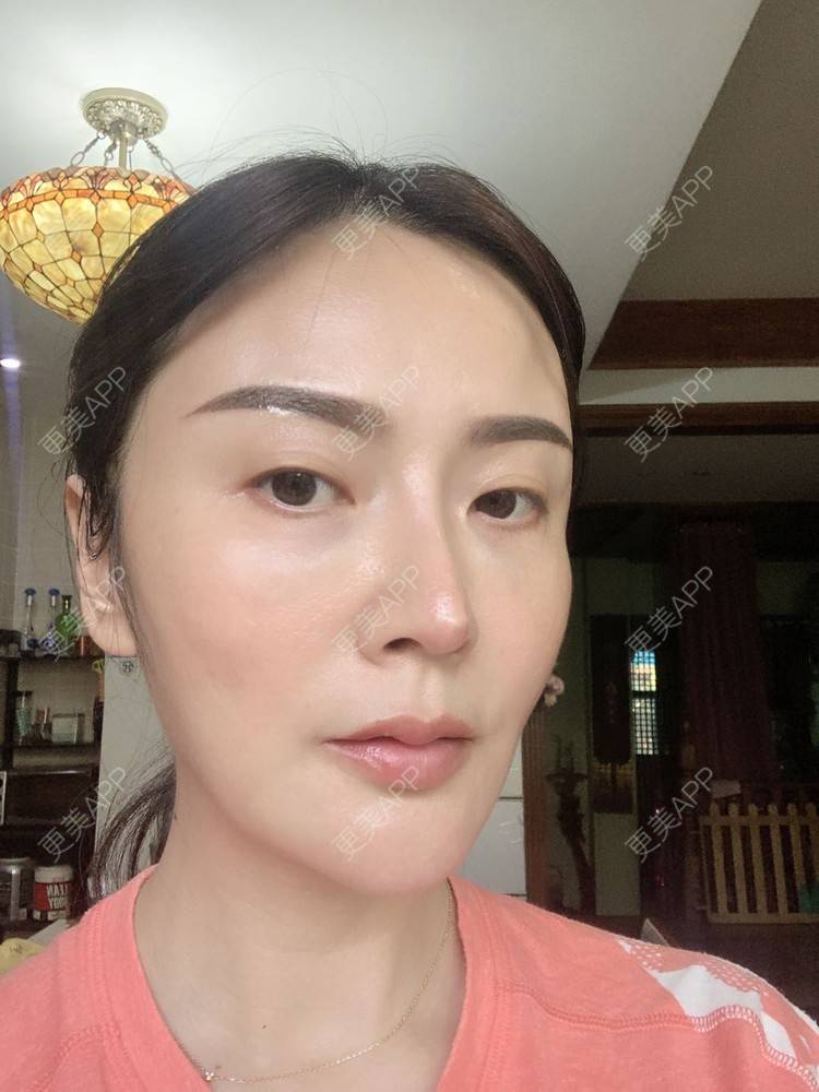 更美 - 更美用户tmzA925IQh的埋线提升经验 | 上海 | 埋线提升