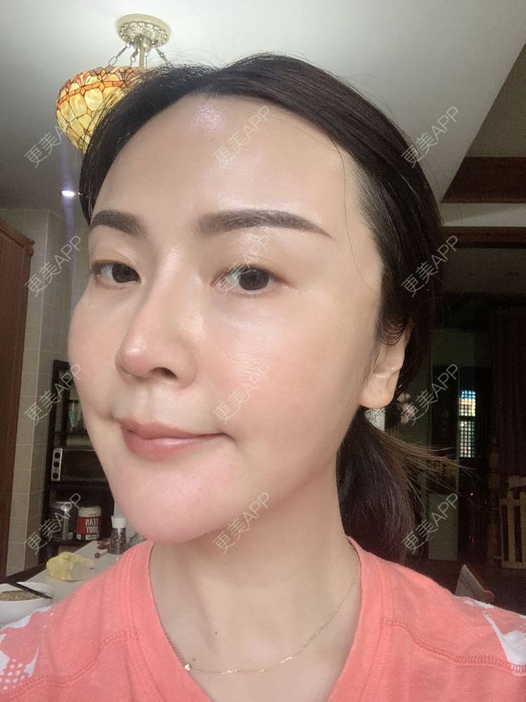 更美 - 更美用户tmzA925IQh的埋线提升经验 | 上海 | 埋线提升