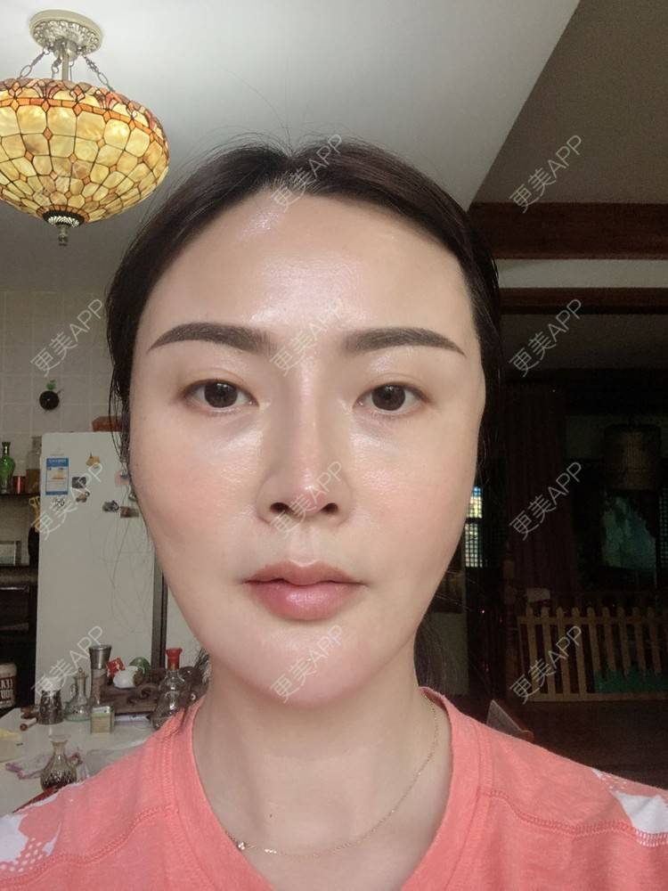 更美 - 更美用户tmzA925IQh的埋线提升经验 | 上海 | 埋线提升