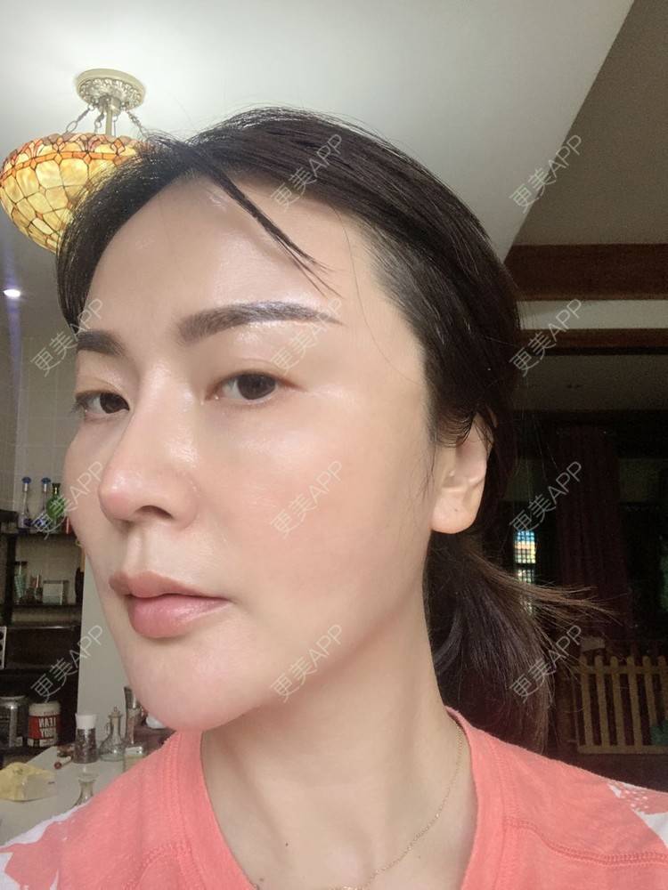 更美 - 更美用户tmzA925IQh的埋线提升经验 | 上海 | 埋线提升