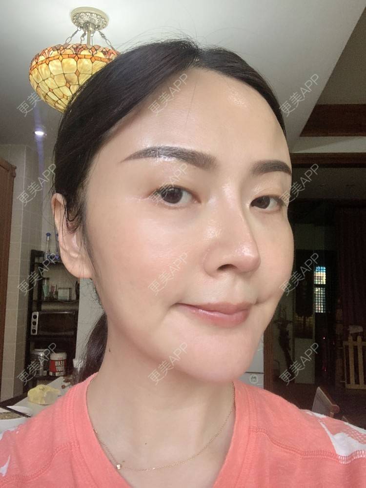 更美 - 更美用户tmzA925IQh的埋线提升经验 | 上海 | 埋线提升