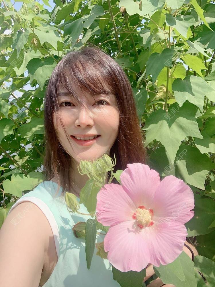 更美 - 更美用户tmzA925IQh的埋线提升经验 | 上海 | 埋线提升