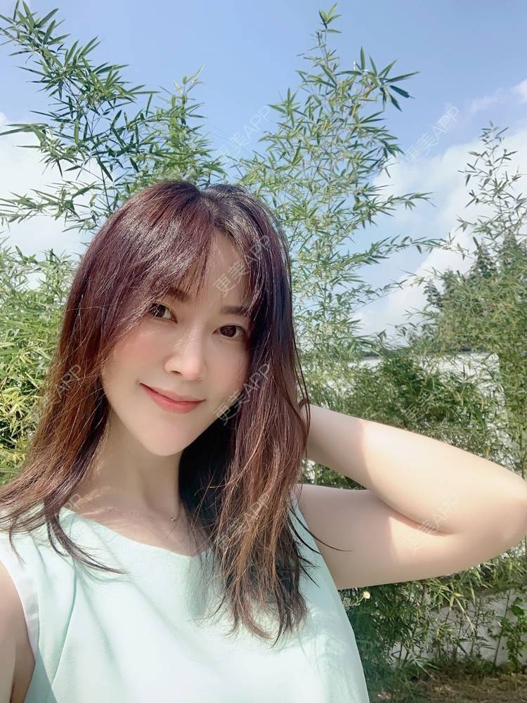 更美 - 更美用户tmzA925IQh的埋线提升经验 | 上海 | 埋线提升