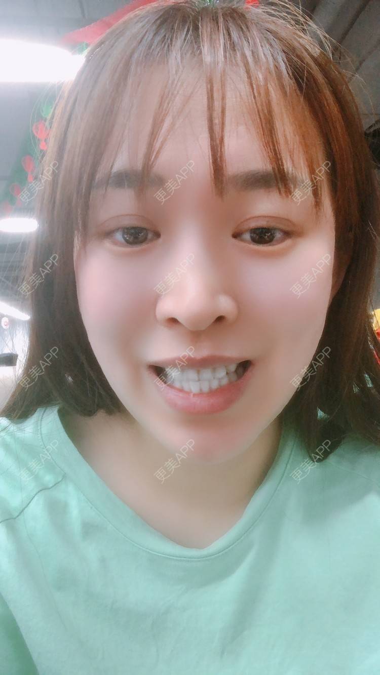 更美 - 更美用户nOSa2OXrxm的冷光美白经验 | 北京 | 冷光美白