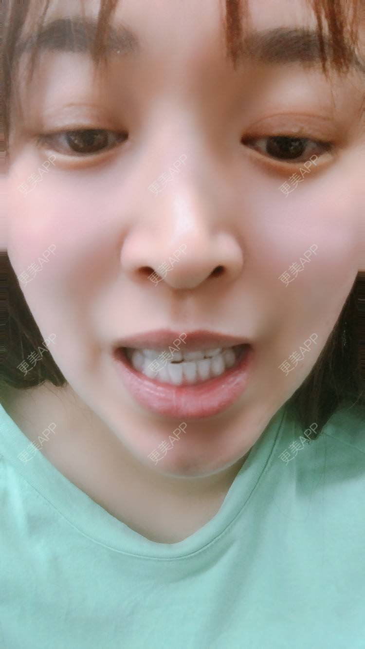更美 - 更美用户nOSa2OXrxm的冷光美白经验 | 北京 | 冷光美白