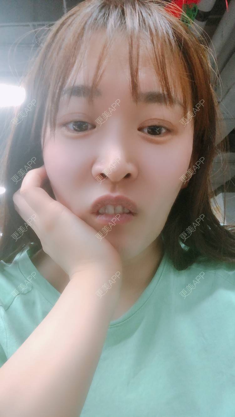 更美 - 更美用户nOSa2OXrxm的冷光美白经验 | 北京 | 冷光美白