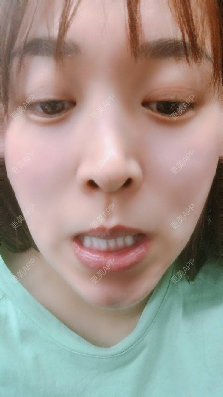 更美 - 更美用户nOSa2OXrxm的冷光美白经验 | 北京 | 冷光美白