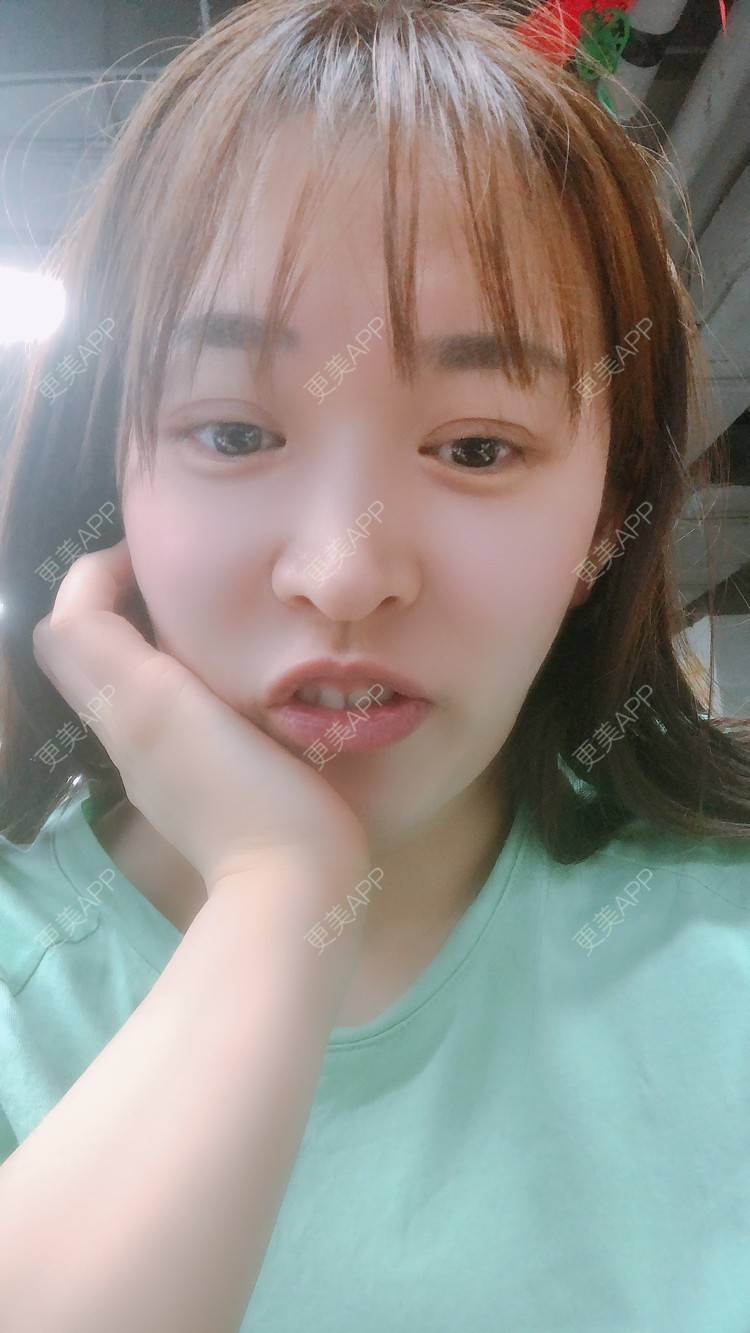 更美 - 更美用户nOSa2OXrxm的冷光美白经验 | 北京 | 冷光美白