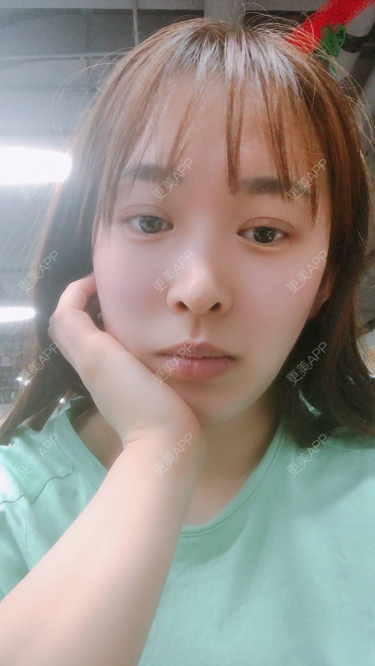 更美 - 更美用户nOSa2OXrxm的冷光美白经验 | 北京 | 冷光美白