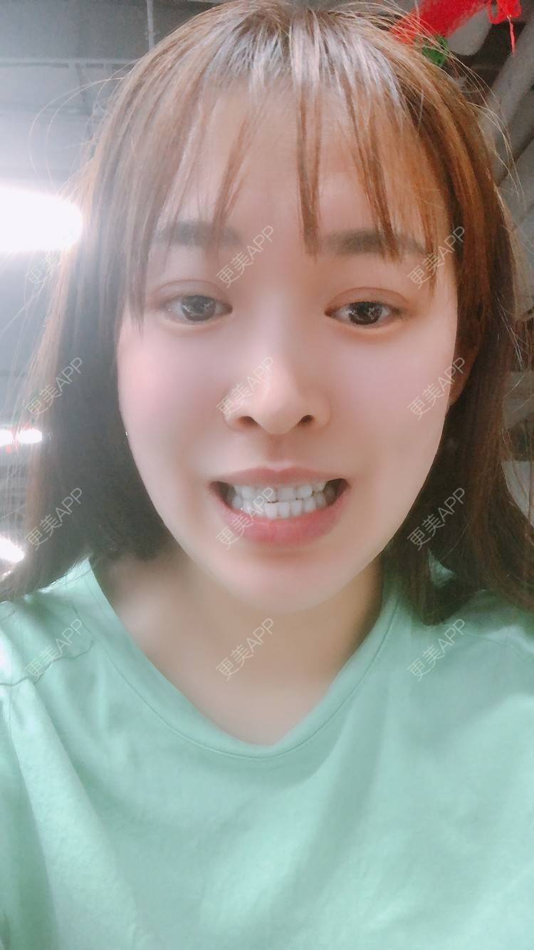 更美 - 更美用户nOSa2OXrxm的冷光美白经验 | 北京 | 冷光美白
