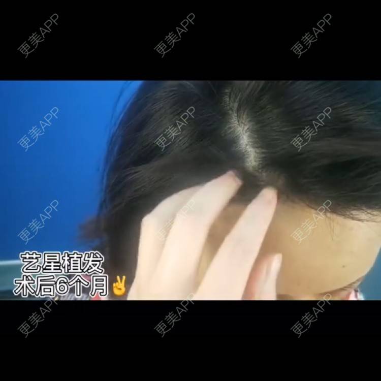 更美 - Lisa baby的植眉经验 | 植发际线 | 植眉 | 昆明
