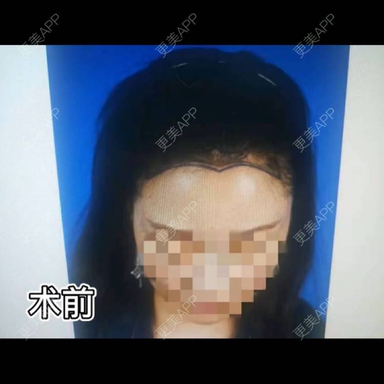 更美 - Lisa baby的植眉经验 | 植发际线 | 植眉 | 昆明