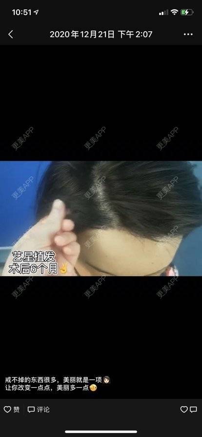 更美 - Lisa baby的植眉经验 | 植发际线 | 植眉 | 昆明