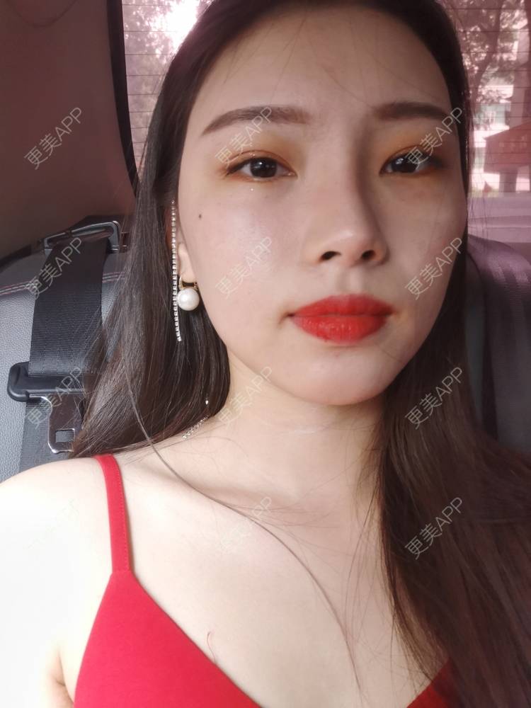 更美 - 更美用户82701801的隐形牙齿矫正经验 | 杭州