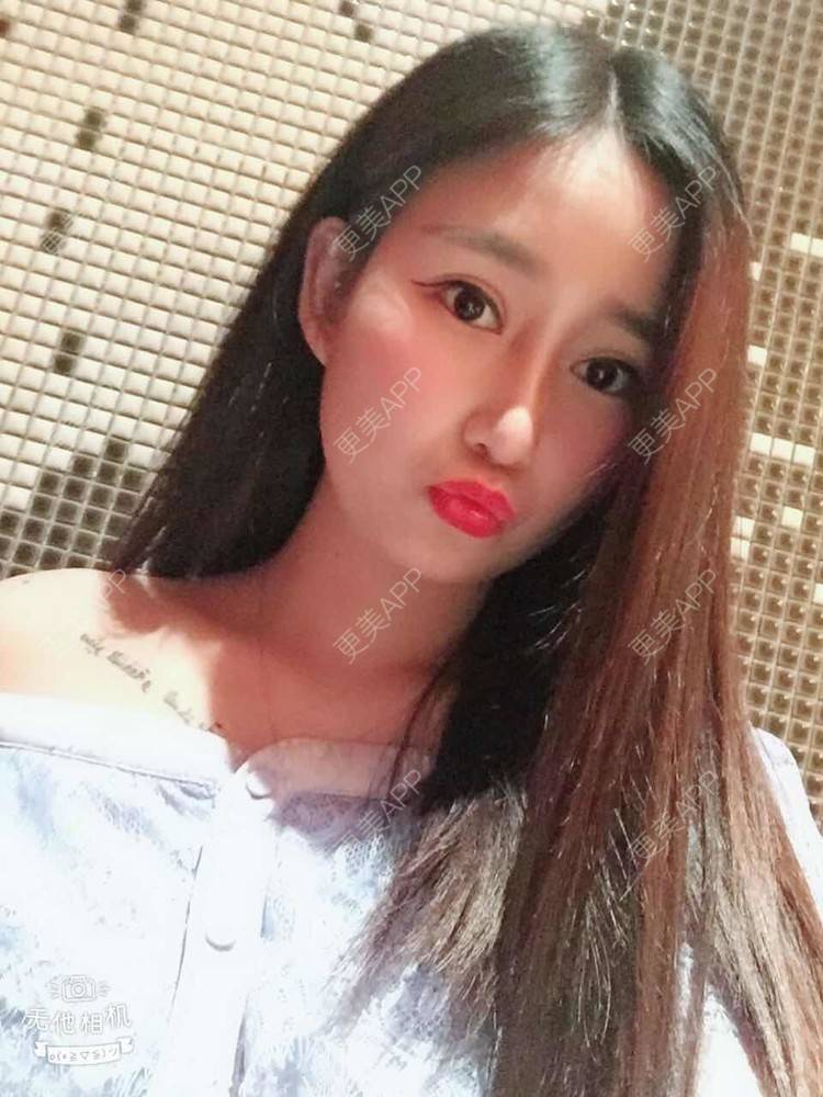 更美 - 一抹花色的双眼皮经验 | 双眼皮 | 重庆