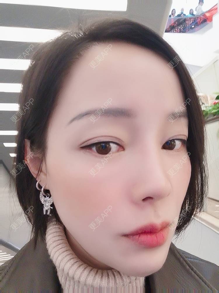 更美 - 🐷🐮仔仔仔的热玛吉经验 | 上海 | 热玛吉