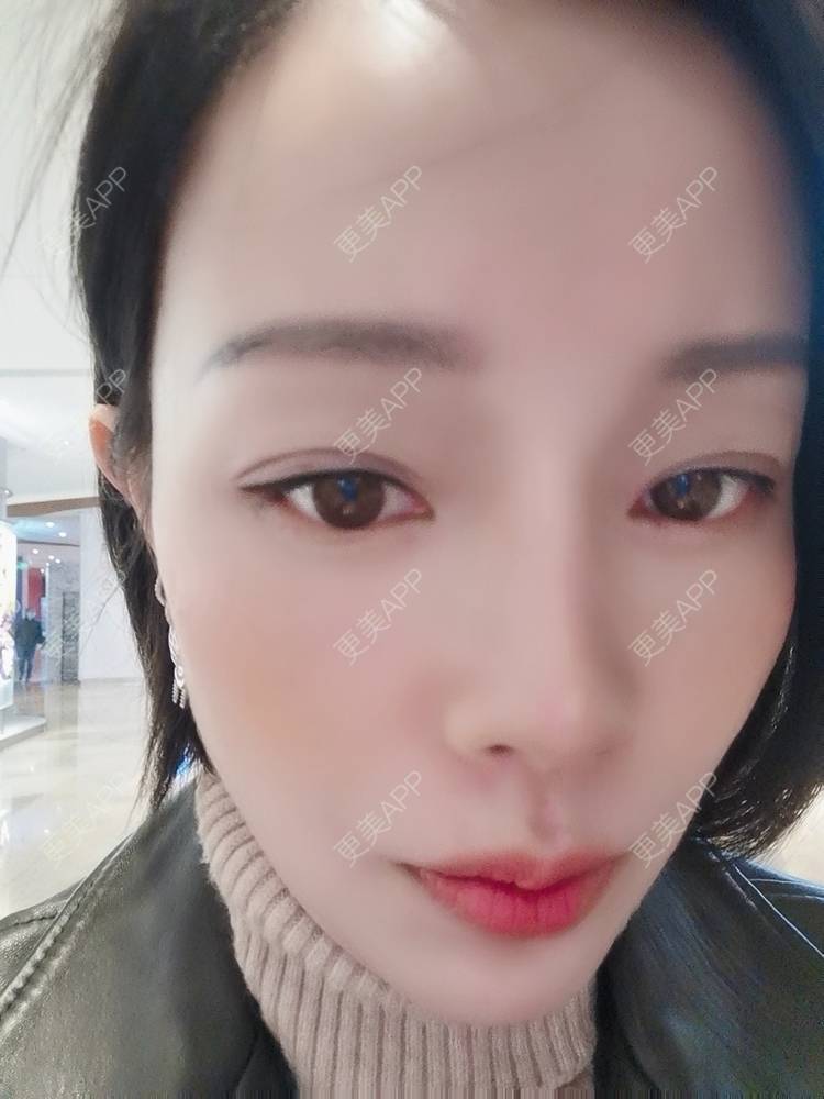 更美 - 🐷🐮仔仔仔的热玛吉经验 | 上海 | 热玛吉