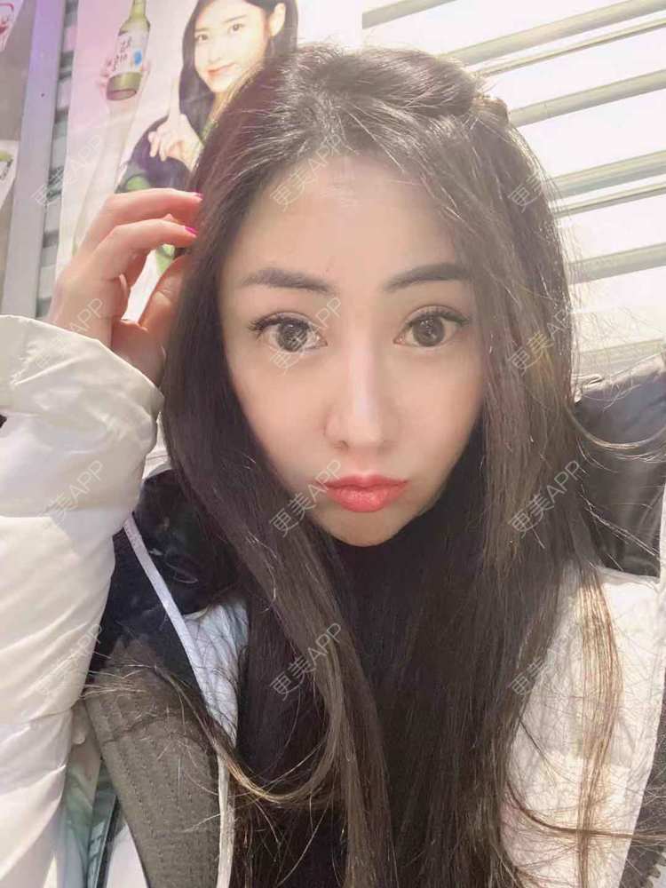 更美 - 大鱼海棠依旧的鼻部膨体假体取出经验 | 假体垫鼻基底 | 自体肋软骨垫鼻基底 | 鼻部多项 | 鼻形态修复 | 肋软骨隆鼻 | 鼻部膨体假体取出 | 鼻翼缩小 | 鼻基底 | 鼻小柱延长 | 鼻部硅胶假体取出 | 耳软骨隆鼻