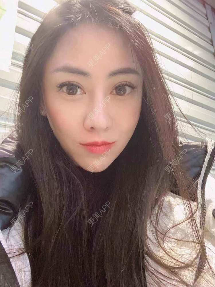 更美 - 大鱼海棠依旧的鼻部膨体假体取出经验 | 假体垫鼻基底 | 自体肋软骨垫鼻基底 | 鼻部多项 | 鼻形态修复 | 肋软骨隆鼻 | 鼻部膨体假体取出 | 鼻翼缩小 | 鼻基底 | 鼻小柱延长 | 鼻部硅胶假体取出 | 耳软骨隆鼻