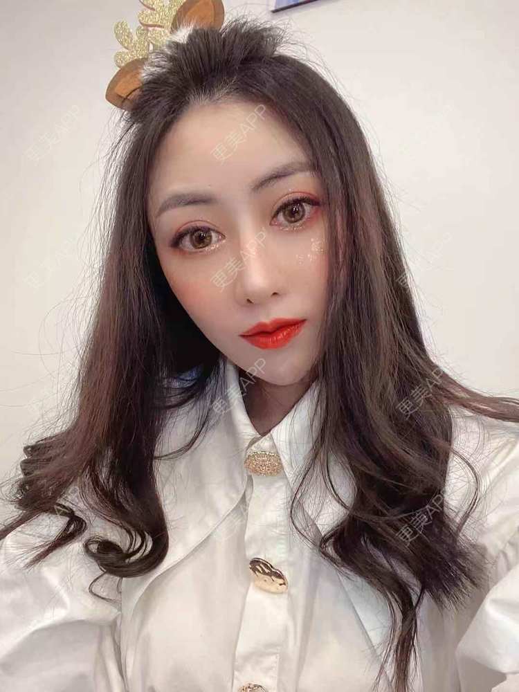 更美 - 大鱼海棠依旧的鼻部膨体假体取出经验 | 假体垫鼻基底 | 自体肋软骨垫鼻基底 | 鼻部多项 | 鼻形态修复 | 肋软骨隆鼻 | 鼻部膨体假体取出 | 鼻翼缩小 | 鼻基底 | 鼻小柱延长 | 鼻部硅胶假体取出 | 耳软骨隆鼻