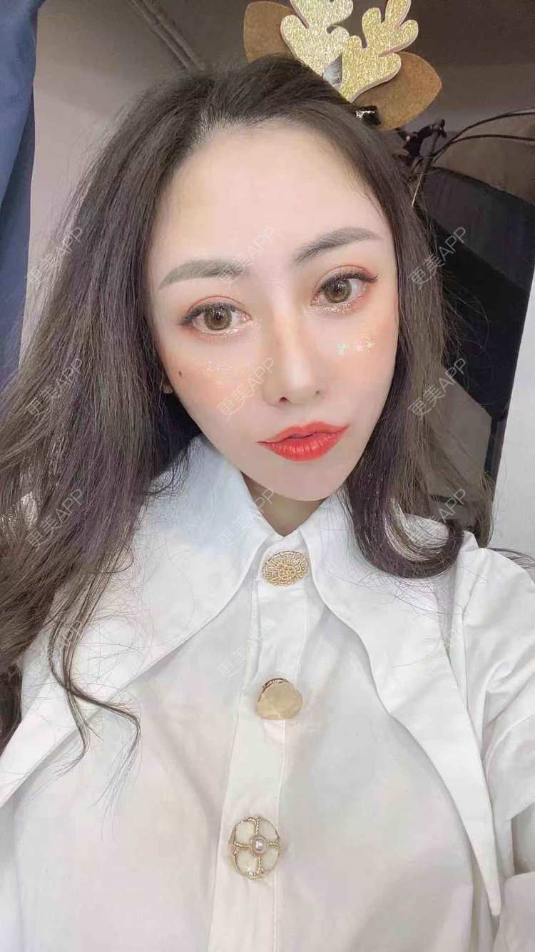 更美 - 大鱼海棠依旧的鼻部膨体假体取出经验 | 假体垫鼻基底 | 自体肋软骨垫鼻基底 | 鼻部多项 | 鼻形态修复 | 肋软骨隆鼻 | 鼻部膨体假体取出 | 鼻翼缩小 | 鼻基底 | 鼻小柱延长 | 鼻部硅胶假体取出 | 耳软骨隆鼻