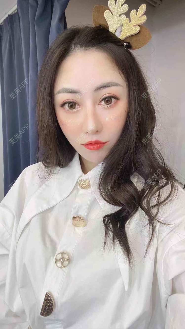 更美 - 大鱼海棠依旧的鼻部膨体假体取出经验 | 假体垫鼻基底 | 自体肋软骨垫鼻基底 | 鼻部多项 | 鼻形态修复 | 肋软骨隆鼻 | 鼻部膨体假体取出 | 鼻翼缩小 | 鼻基底 | 鼻小柱延长 | 鼻部硅胶假体取出 | 耳软骨隆鼻