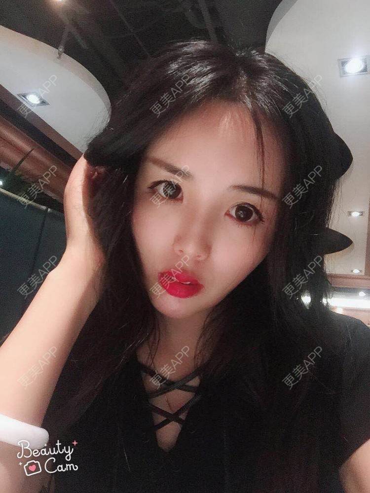 更美 - 活成一首诗的自体脂肪面部年轻化经验 | 北京 | 自体脂肪面部年轻化