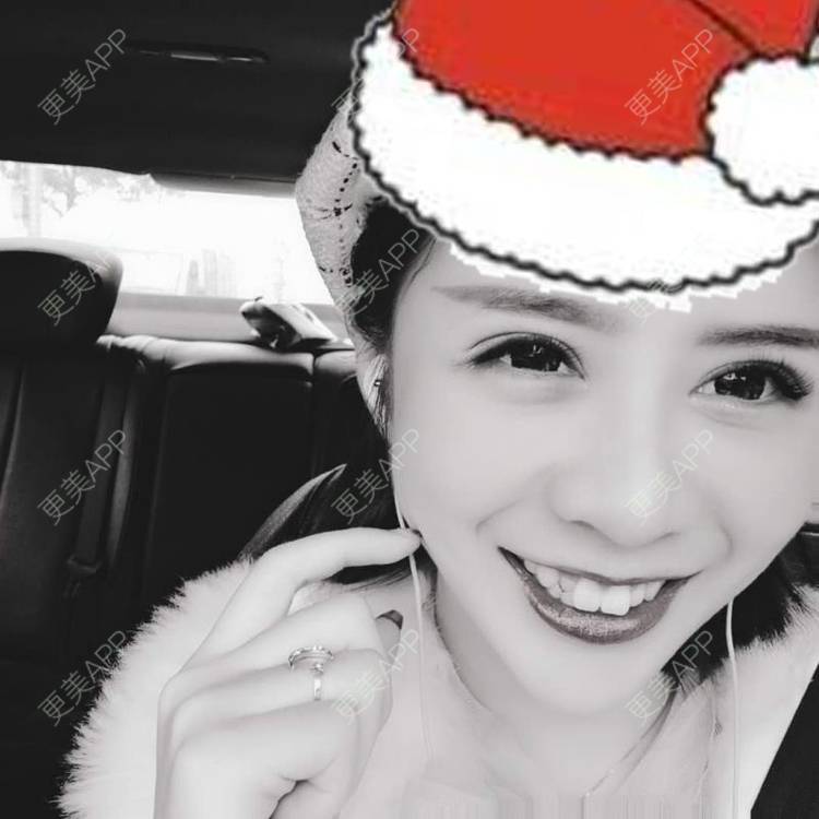 更美 - 哑琳的自体脂肪丰苹果肌经验 | 自体脂肪丰苹果肌 | 自体脂肪垫下巴 | 自体脂肪丰额头 | 自体脂肪填充法令纹 | 深圳 | 自体脂肪全面部填充