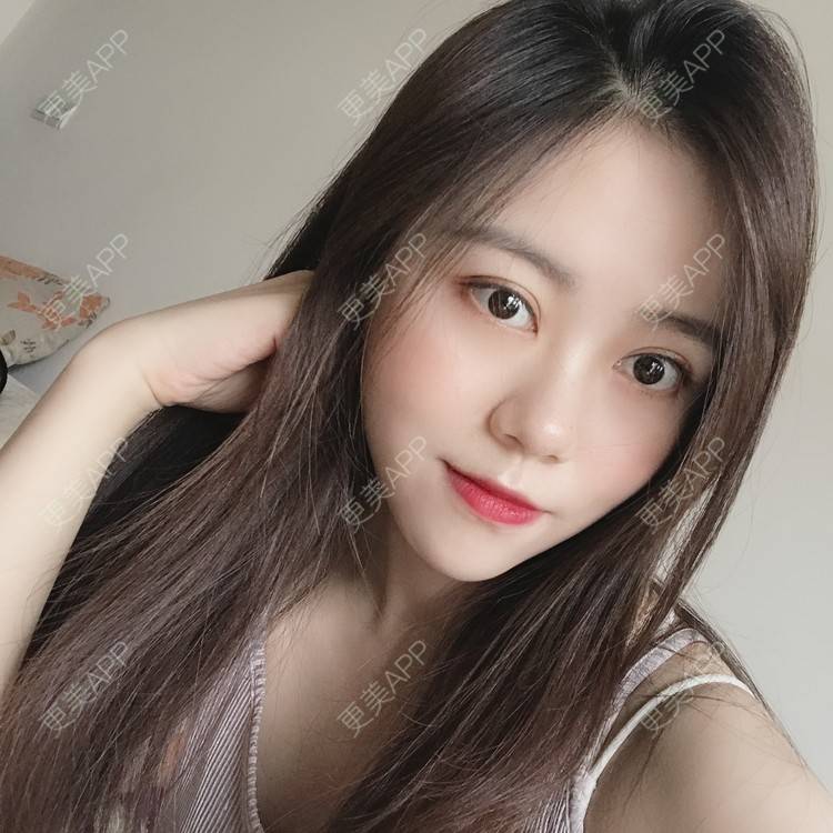 更美 - 渔美人的全切双眼皮经验 | 成都 | 视频日记 | 全切双眼皮 | 双眼皮