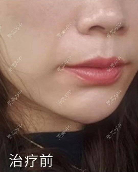 更美 - 涂艳丽 医生的射频提升经验 | 射频提升 | 沈阳