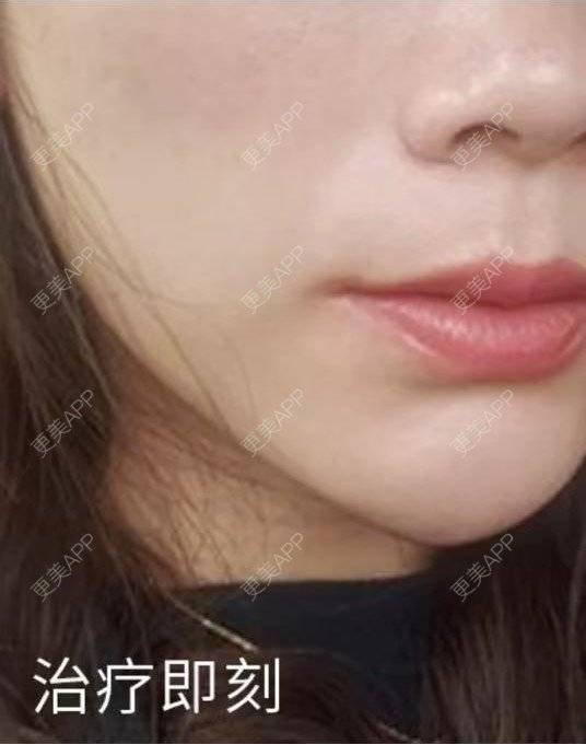 更美 - 涂艳丽 医生的射频提升经验 | 射频提升 | 沈阳