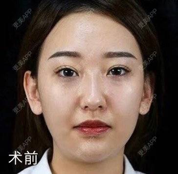 更美 - 涂艳丽 医生的射频提升经验 | 射频提升 | 沈阳
