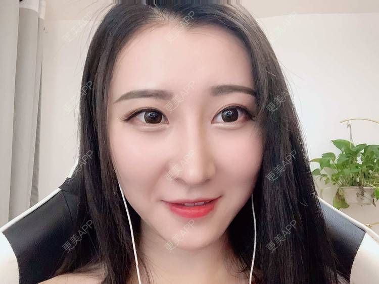 更美 - 徐利利的鼻部修复经验 | 双眼皮修复 | 鼻部修复 | 广州