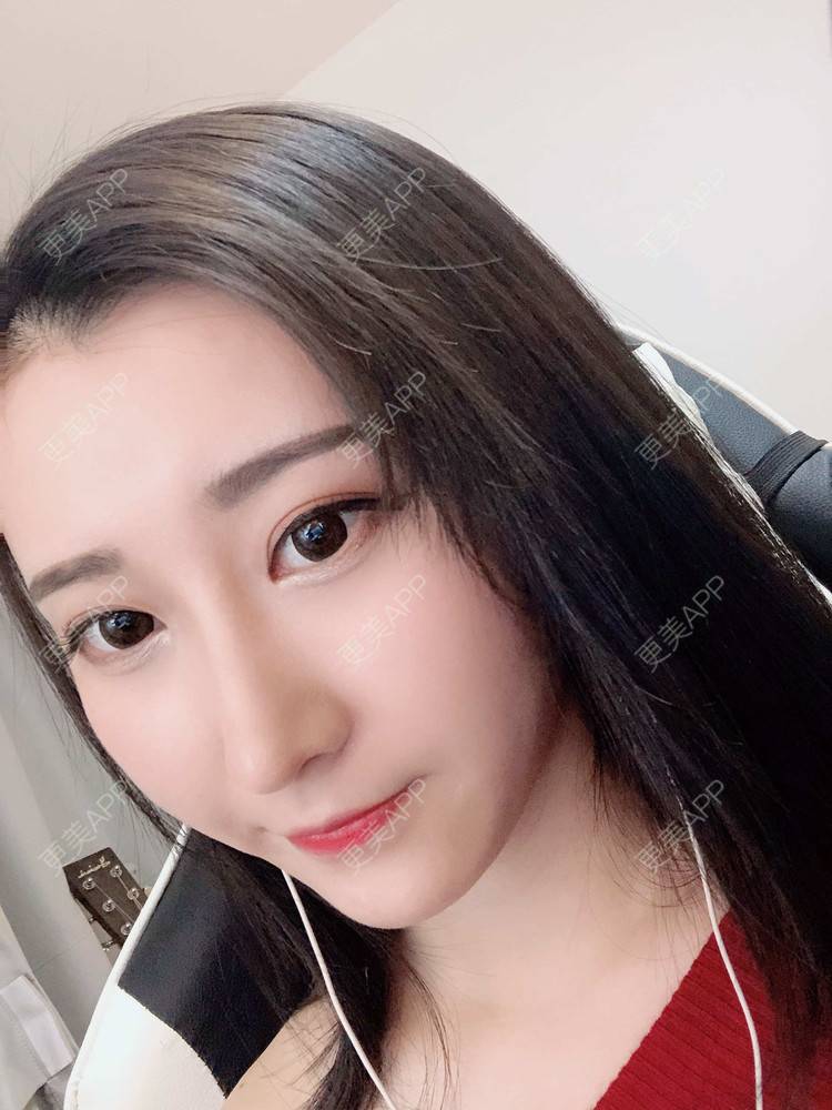 更美 - 徐利利的鼻部修复经验 | 双眼皮修复 | 鼻部修复 | 广州