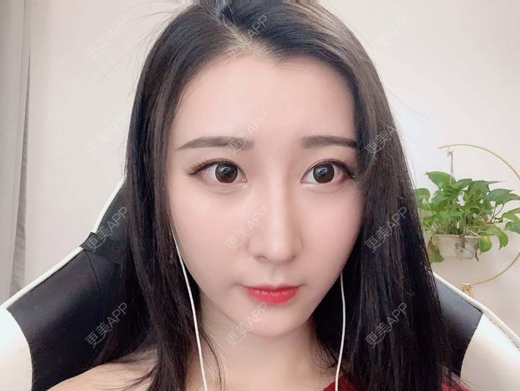 更美 - 徐利利的鼻部修复经验 | 双眼皮修复 | 鼻部修复 | 广州