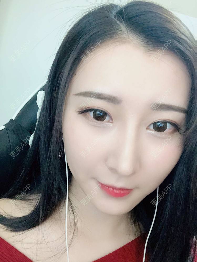 更美 - 徐利利的鼻部修复经验 | 双眼皮修复 | 鼻部修复 | 广州