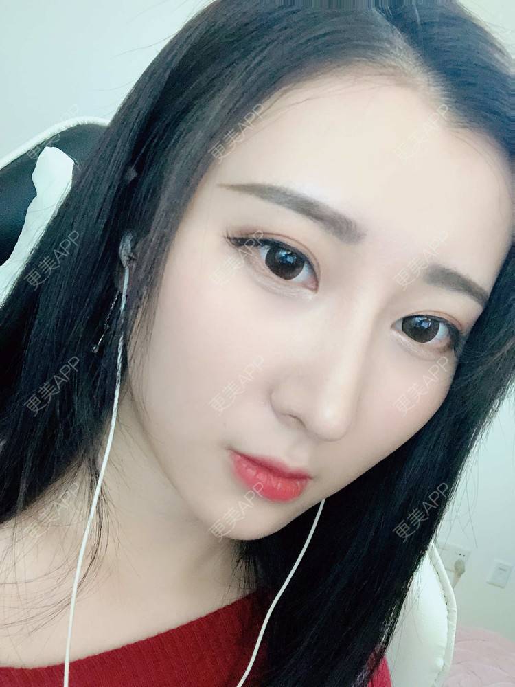 更美 - 徐利利的鼻部修复经验 | 双眼皮修复 | 鼻部修复 | 广州
