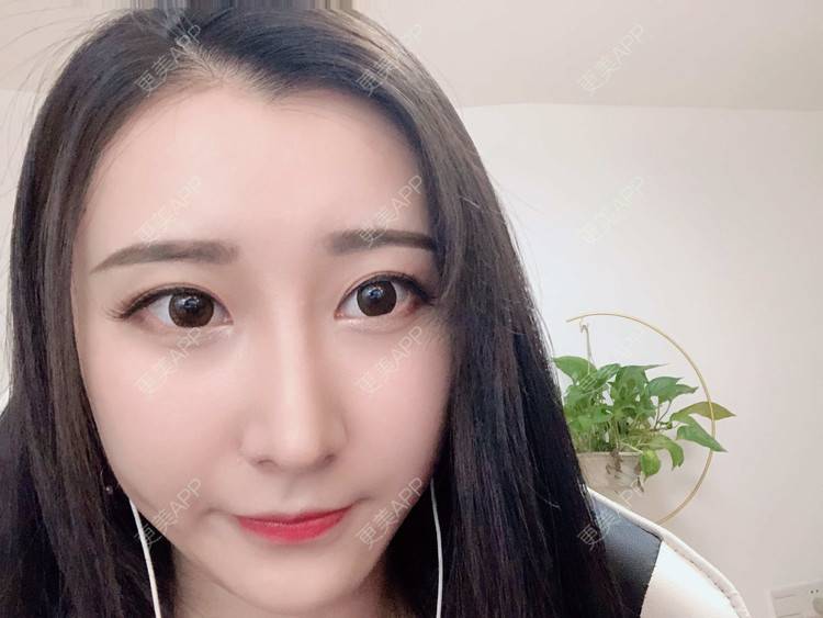 更美 - 徐利利的鼻部修复经验 | 双眼皮修复 | 鼻部修复 | 广州