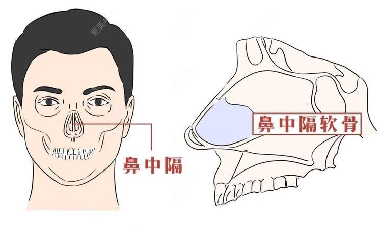 更美 - 吴松 医生的肋软骨隆鼻经验 | 鼻中隔软骨隆鼻 | 重庆