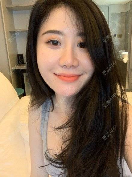 更美 - 更美用户F9mNhf6bwI的改善动态纹经验 | 改善动态纹 | 上海
