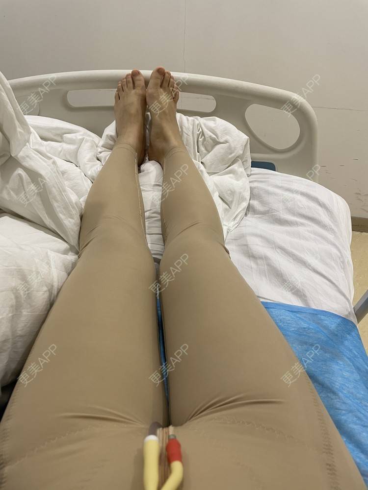 更美 - 更美用户TTx0mKb4QJ的吸脂瘦大腿经验 | 吸脂瘦大腿 | 广州