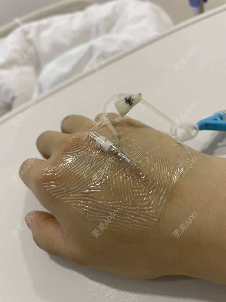 更美 - 更美用户TTx0mKb4QJ的吸脂瘦大腿经验 | 吸脂瘦大腿 | 广州