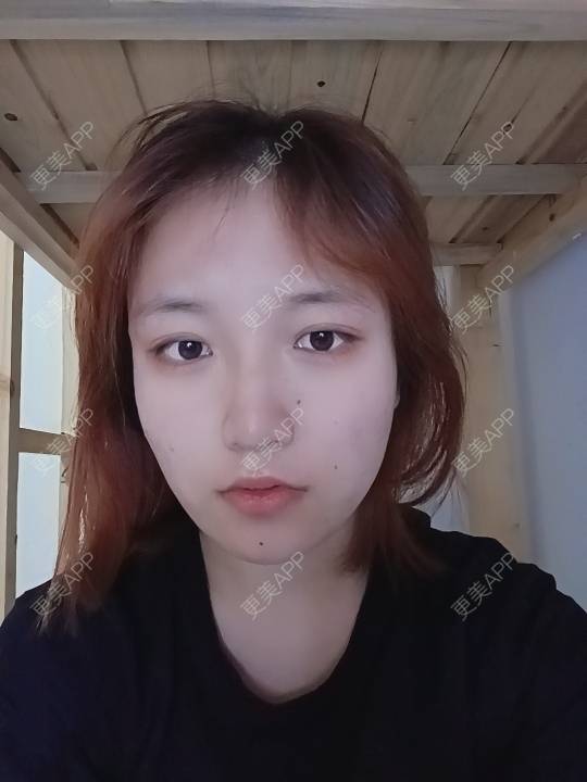 更美 - 更美用户tbs28rKiLZ的玻尿酸卧蚕经验 | 玻尿酸卧蚕 | 杭州
