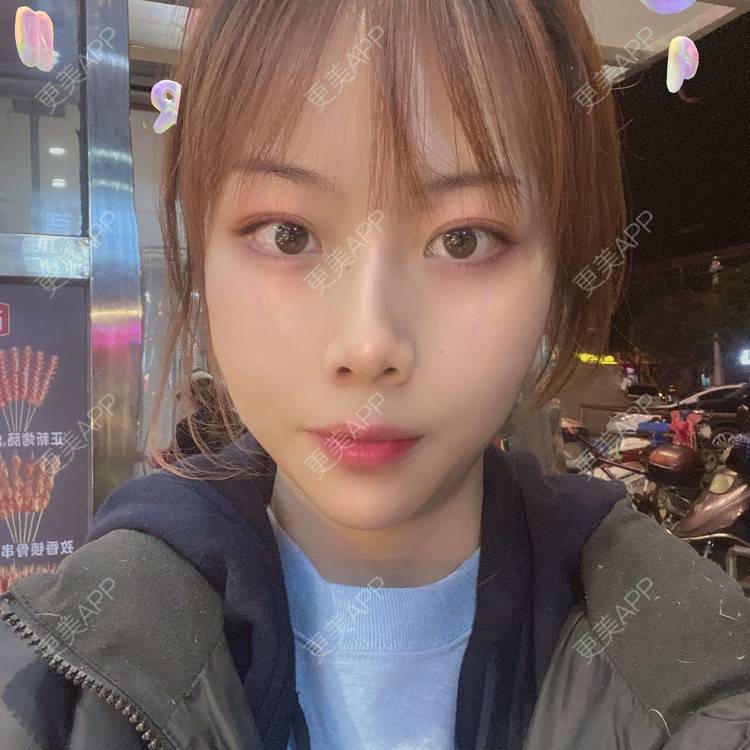 更美 - 悦悦悦耳的双眼皮经验 | 广州 | 双眼皮