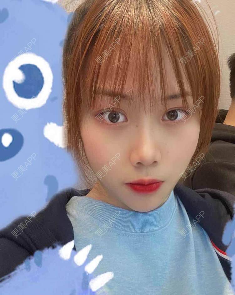 更美 - 悦悦悦耳的双眼皮经验 | 广州 | 双眼皮