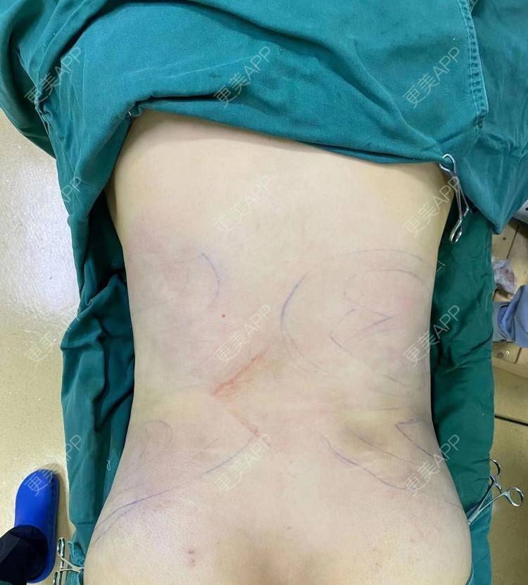 更美 - 更美用户XSHxrZJ1zJ的射频溶脂瘦腰部经验 | 射频溶脂瘦腰部
